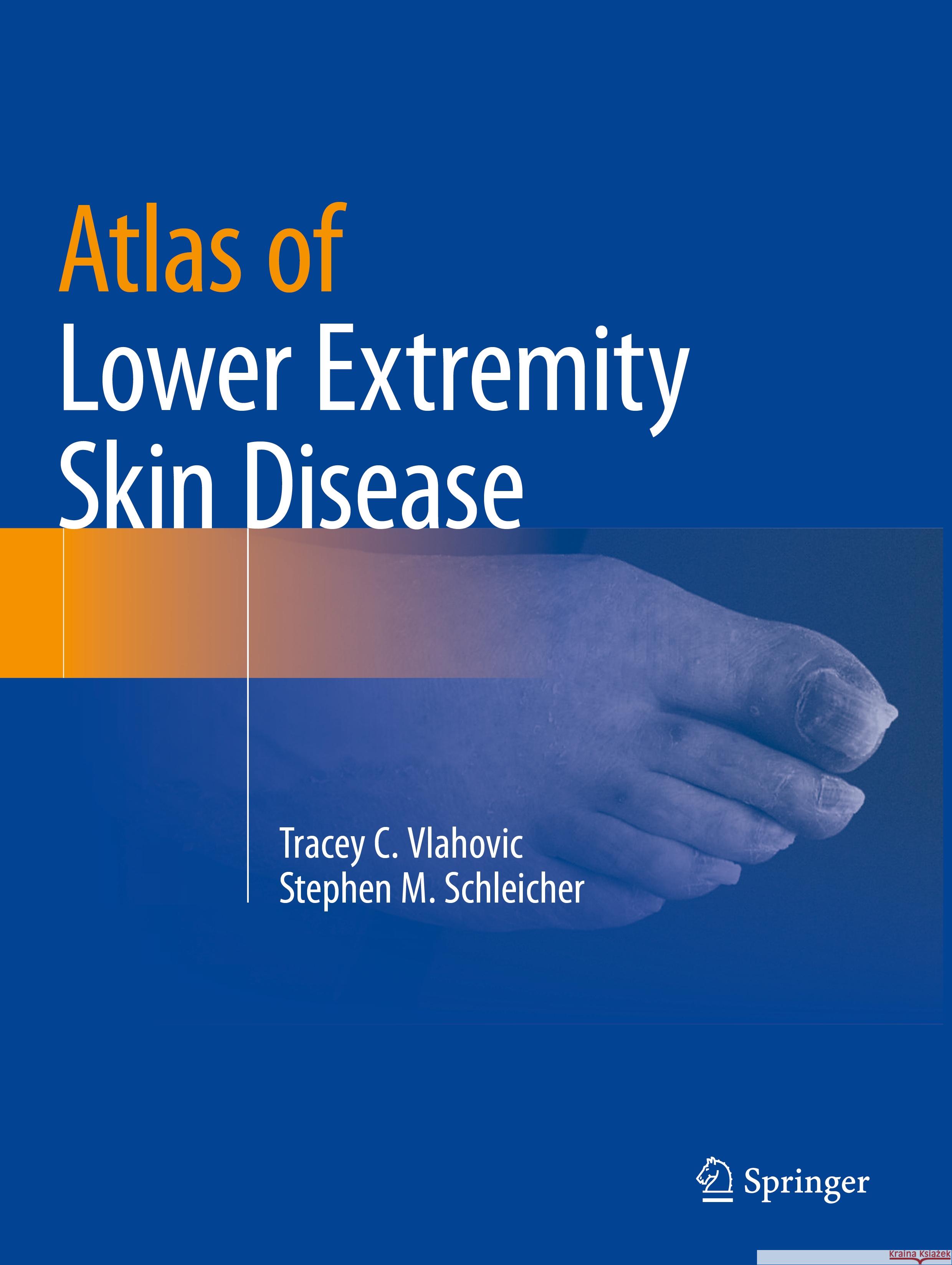 Atlas of Lower Extremity Skin Disease Tracey C. Vlahovic, Stephen M. Schleicher 9783031079528 Springer International Publishing