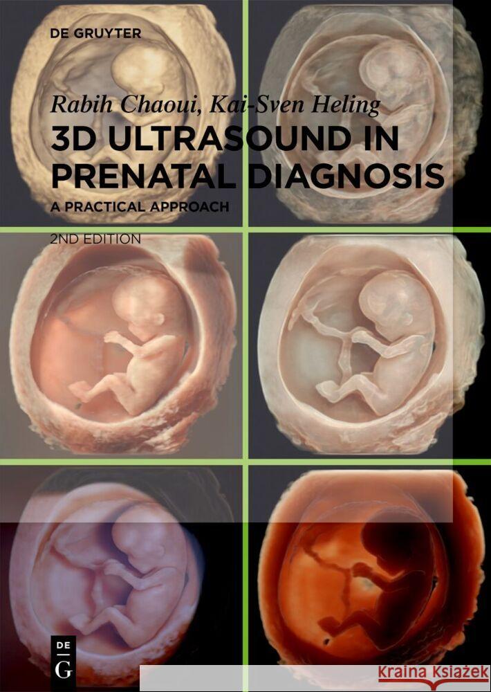 3D Ultrasound in Prenatal Diagnosis: A Practical Approach Rabih Chaoui Kai-Sven Heling 9783111249094 de Gruyter