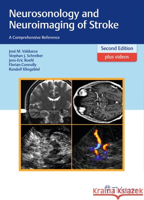 Neurosonology and Neuroimaging of Stroke: A Comprehensive Reference Valdueza, José Manuel 9783131418722 Tps