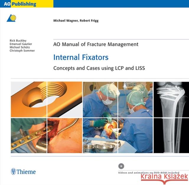 Ao Manual of Fracture Management: Internal Fixators: Concepts and Cases Using Lcp/Liss Wagner, Michael 9783131435514 Thieme Publishing Group