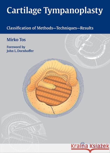 Cartilage Tympanoplasty: Classification of Methods - Techniques - Results Tos, Mirko 9783131450913 Thieme Medical Publishers