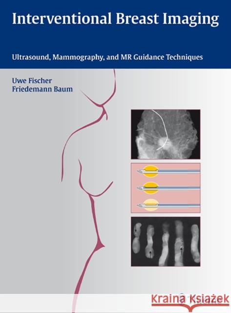 Interventional Breast Imaging: Ultrasound, Mammography, and MR Guidance Techniques Fischer, Uwe 9783131467010 Thieme Medical Publishers