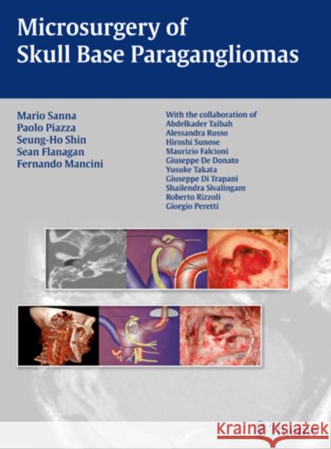 Microsurgery of Skull Base Paragangliomas Mario et al Sanna 9783131486110 Thieme, Stuttgart