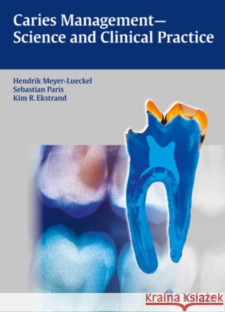 Caries Management - Science and Clinical Practice   9783131547118 Thieme, Stuttgart