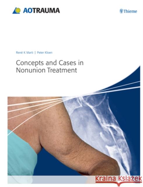 Concepts and Cases in Nonunion Treatment Marti, Rene K.  ; Kloen, Peter 9783131658517