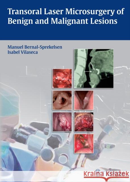 Transoral Laser Microsurgery of Benign and Malignant Lesions Manuel Bernal-Sprekelsen Isabel Vilaseca  9783131723918 Thieme Publishing Group