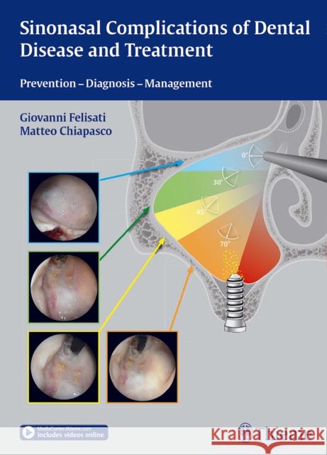 Sinonasal Complications of Dental Disease and Treatment: Prevention - Diagnosis - Management Felisati, Giovanni 9783131997012 Thieme Medical Publishers