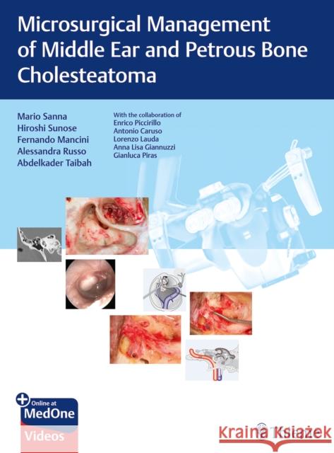 Microsurgical Management of Middle Ear and Petrous Bone Cholesteatoma Sanna, Mario 9783132000056 Thieme Medical Publishers