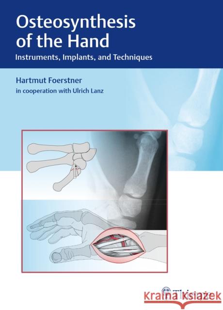 Osteosynthesis of the Hand: Instruments, Implants, and Techniques Förstner, Hartmut 9783132038110