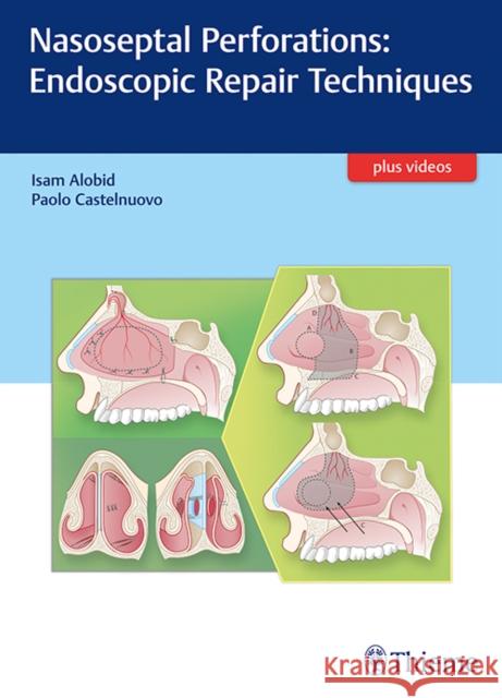 Nasoseptal Perforations: Endoscopic Repair Techniques Isam Alobid Paolo Castelnuovo 9783132053915 Tps