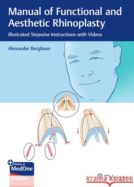 Manual of Functional and Aesthetic Rhinoplasty: Illustrated Stepwise Instructions with Videos Alexander Berghaus 9783132412781 Thieme Publishing Group