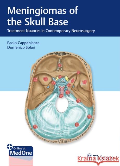 Meningiomas of the Skull Base: Treatment Nuances in Contemporary Neurosurgery Cappabianca, Paolo 9783132412866 Tps