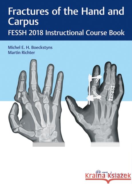 Fractures of the Hand and Carpus: Fessh 2018 Instructional Course Book Boeckstyns, Michel E. H. 9783132417205 Thieme Medical Publishers