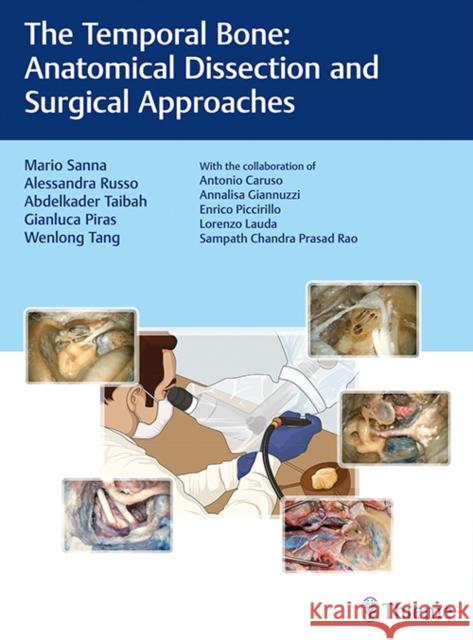 The Temporal Bone: Anatomical Dissection and Surgical Approaches Sanna, Mario 9783132419346 Tps