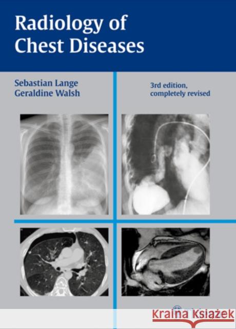 Radiology of Chest Diseases Sebastian Lange Geraldine Walsh  9783137407034 Thieme Publishing Group