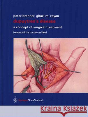 Dupuytren's Disease: A Concept of Surgical Treatment Brenner, Peter 9783211836569
