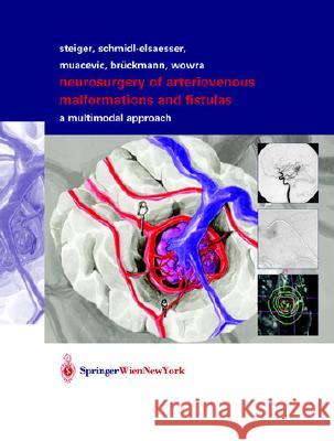 Neurosurgery of Arteriovenous Malformations and Fistulas: A Multimodal Approach Schmid-Elsaesser, Robert 9783211837030 Springer