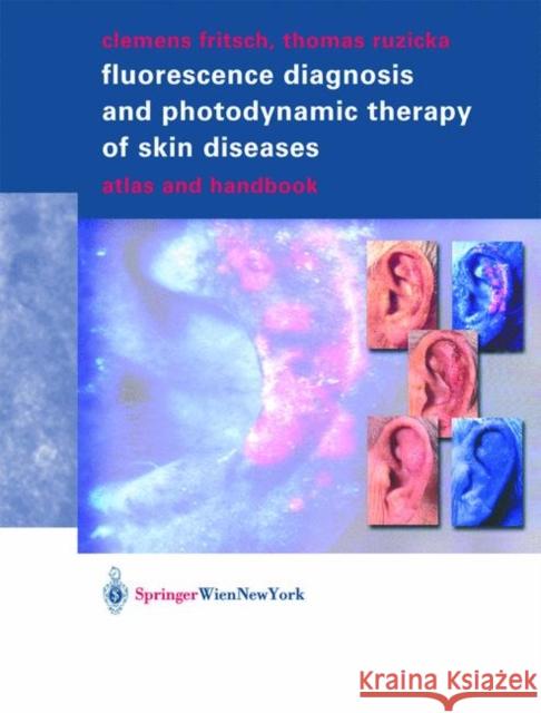 Fluorescence Diagnosis and Photodynamic Therapy of Skin Diseases: Atlas and Handbook Fritsch, Clemens 9783211838273 Springer