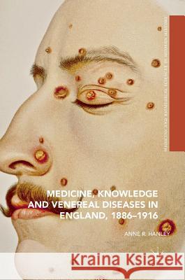 Medicine, Knowledge and Venereal Diseases in England, 1886-1916 Anne Hanley 9783319324548 Palgrave MacMillan