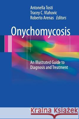 Onychomycosis: An Illustrated Guide to Diagnosis and Treatment Tosti, Antonella 9783319448527