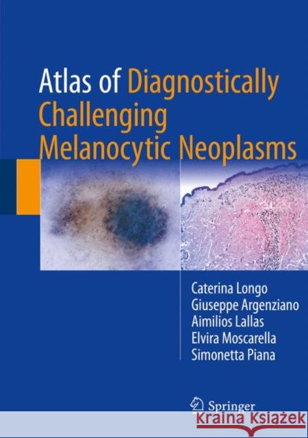 Atlas of Diagnostically Challenging Melanocytic Neoplasms Caterina Longo Giuseppe Argenziano Aimilios Lallas 9783319486512
