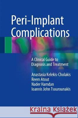 Peri-Implant Complications: A Clinical Guide to Diagnosis and Treatment Kelekis-Cholakis, Anastasia 9783319637174 Springer