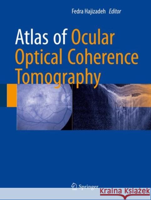 Atlas of Ocular Optical Coherence Tomography Fedra Hajizadeh 9783319667560 Springer International Publishing AG