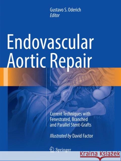 Endovascular Aortic Repair: Current Techniques with Fenestrated, Branched and Parallel Stent-Grafts Oderich, Gustavo S. 9783319792149 Springer