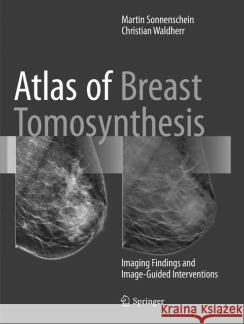 Atlas of Breast Tomosynthesis: Imaging Findings and Image-Guided Interventions Sonnenschein, Martin 9783319793528 Springer