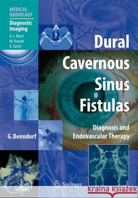 Dural Cavernous Sinus Fistulas : Diagnosis and Endovascular Therapy Goetz Benndorf Benndorf                                 Gtz Benndorf 9783540008187 