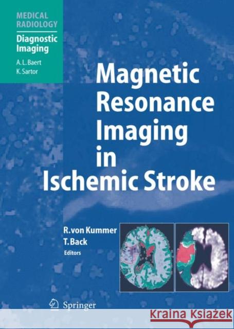 Magnetic Resonance Imaging in Ischemic Stroke Von Kummer, Rüdiger 9783540008613 Springer