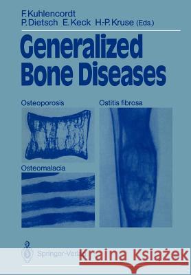 Generalized Bone Diseases: Osteoporosis Osteomalacia Ostitis Fibrosa Kuhlencordt, Friedrich 9783540187899 Springer