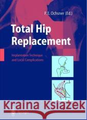 Total Hip Replacement: Implantation Technique and Local Complications Hinchliffe, R. 9783540438762 Springer