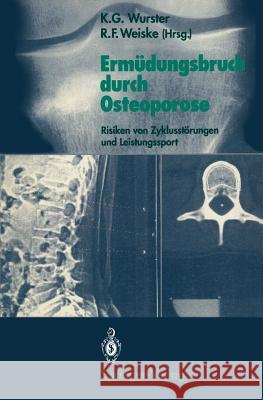 Ermüdungsbruch Durch Osteoporose: Risiken Von Zyklusstörungen Und Leistungssport Wurster, Kurt G. 9783540514442 Not Avail