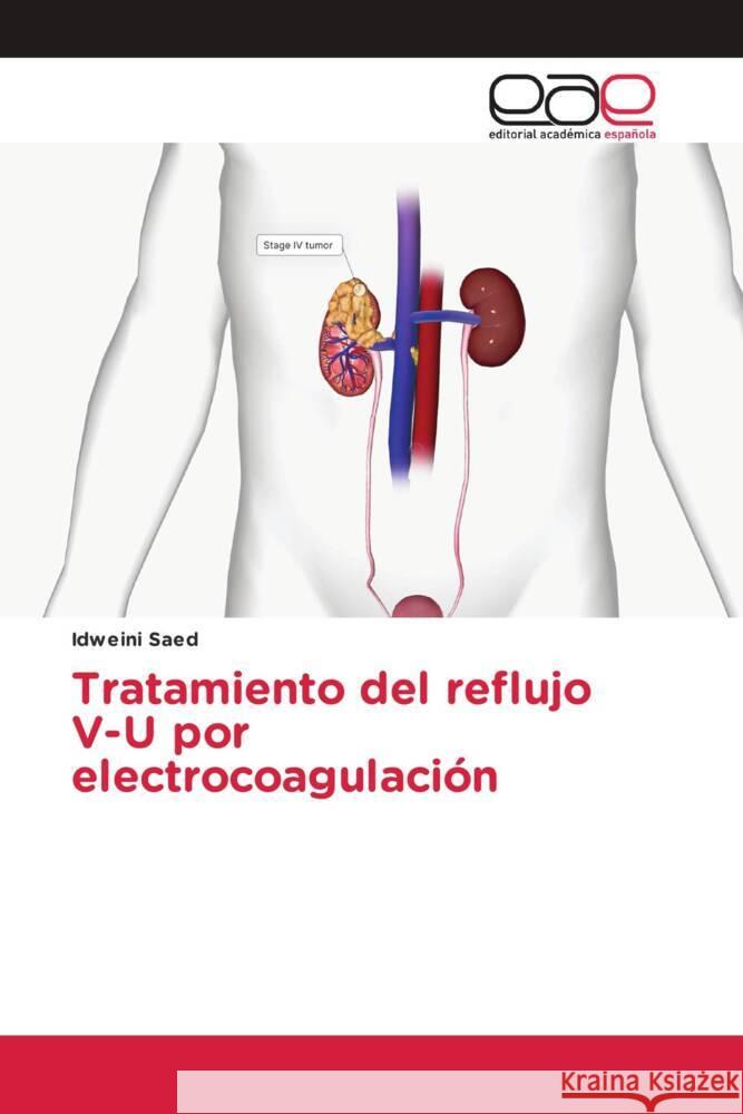 Tratamiento del reflujo V-U por electrocoagulación Saed, Idweini 9783639785241