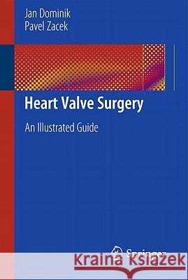Heart Valve Surgery: An Illustrated Guide Dominik, Jan 9783642122057 SPRINGER