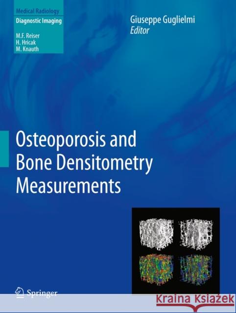 Osteoporosis and Bone Densitometry Measurements Giuseppe Guglielmi 9783642278839 Springer