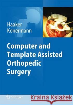 Computer and Template Assisted Orthopedic Surgery Rolf Haaker Werner Konermann 9783642297274 Springer