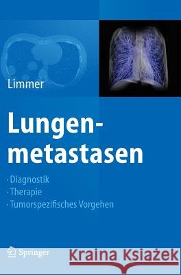 Lungenmetastasen: Diagnostik - Therapie - Tumorspezifisches Vorgehen Limmer, Stefan 9783642329814
