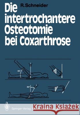 Die intertrochantere Osteotomie bei Coxarthrose R. Schneider 9783642480751 Springer-Verlag Berlin and Heidelberg GmbH & 