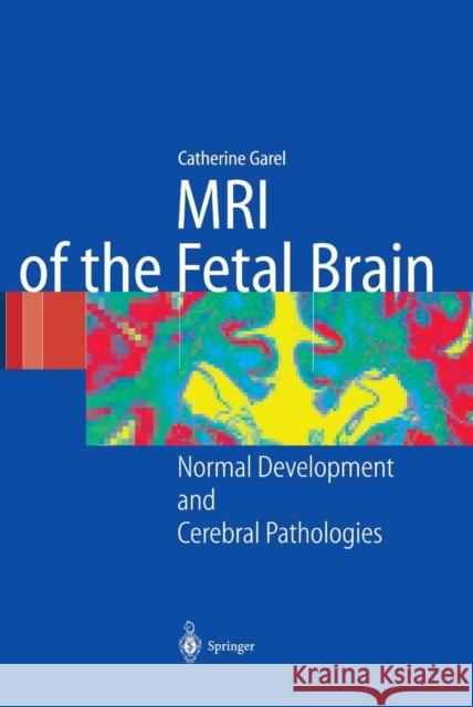 MRI of the Fetal Brain: Normal Development and Cerebral Pathologies Garel, C. 9783642622755 Springer