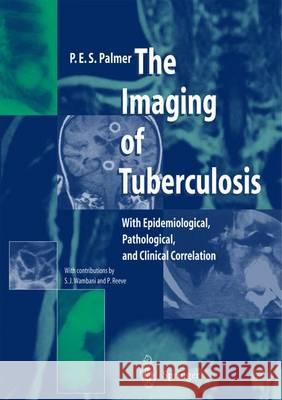 The Imaging of Tuberculosis: With Epidemiological, Pathological, and Clinical Correlation Palmer, P. E. S. 9783642626104 Springer