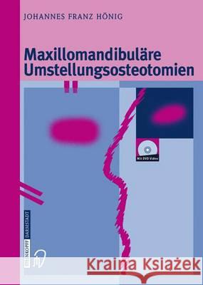 Maxillomandibuläre Umstellungsosteotomien Johannes-Franz Honig 9783642632846 Steinkopff-Verlag Darmstadt