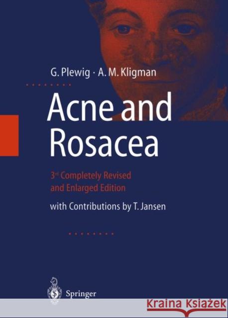 Acne and Rosacea Plewig, G. 9783642640964 Springer, Berlin