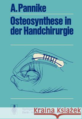 Osteosynthese in Der Handchirurgie Pannike, A. 9783642654282 Springer