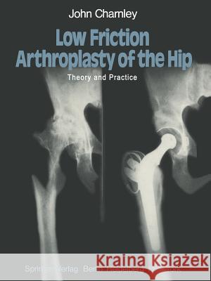Low Friction Arthroplasty of the Hip: Theory and Practice Charnley, J. 9783642670152 Springer