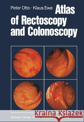 Atlas of Rectoscopy and Coloscopy P. Otto K. Ewe B. Clowdus 9783642672521 Springer