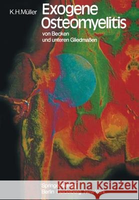 Exogene Osteomyelitis Von Becken Und Unteren Gliedmaßen: Besonderheiten Pathogenese Klinik Therapie Ergebnisse Müller, K. H. 9783642678417 Springer