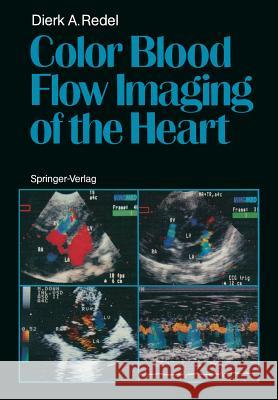 Color Blood Flow Imaging of the Heart Dierk A. Redel 9783642711749 Springer