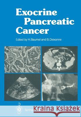 Exocrine Pancreatic Cancer Hughes Baumel Bernard Deixonne H. Sarles 9783642711800 Springer